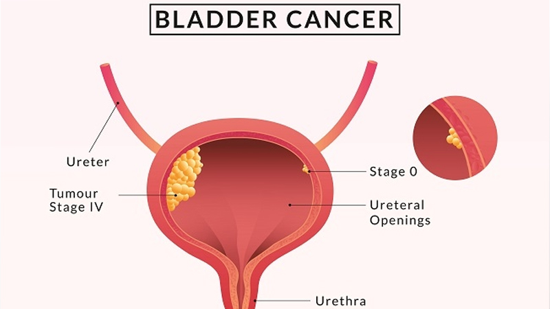 Kanker Saluran Kemih: Tanda-tanda dan Pencegahan dari PAFI Mojosari